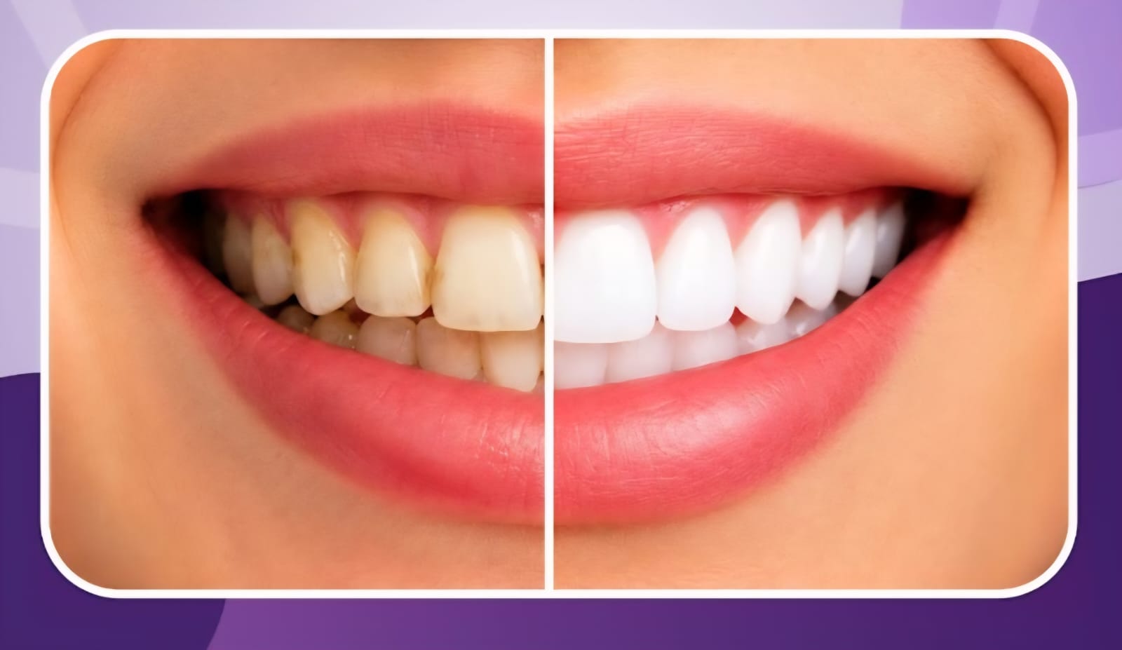Teeth Cleaning & Whitening